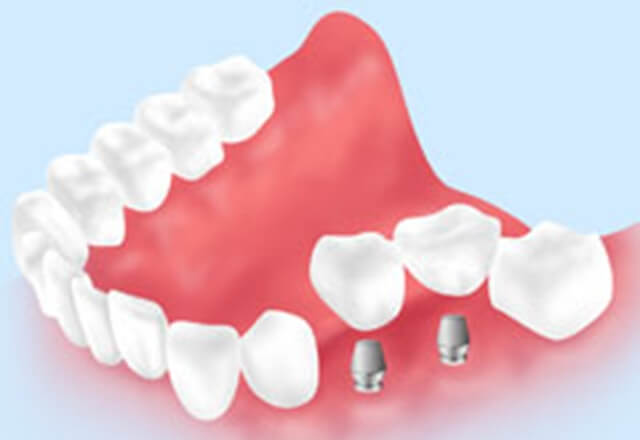 インプラント治療について